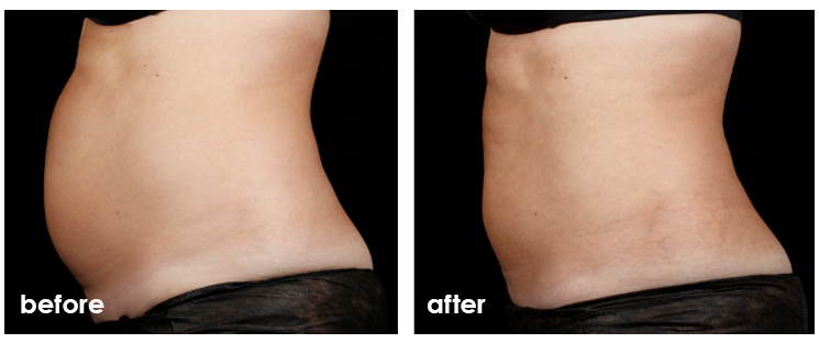 ba_sculpsure-1